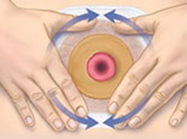 algoritmo-ostomy-convatec-aplicacao-sistemas-estomias-6