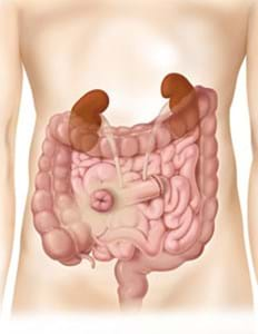 algoritmo-ostomy-convatec-cirurgia-de-urostomia-1