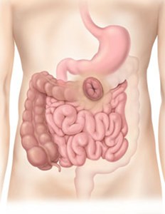 algoritmo-ostomy-convatec-colostomia-transversa